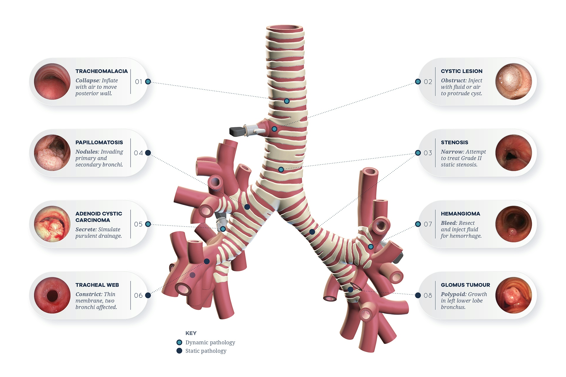 Diagram of dynamic pathology located on inside of simulated trachea.