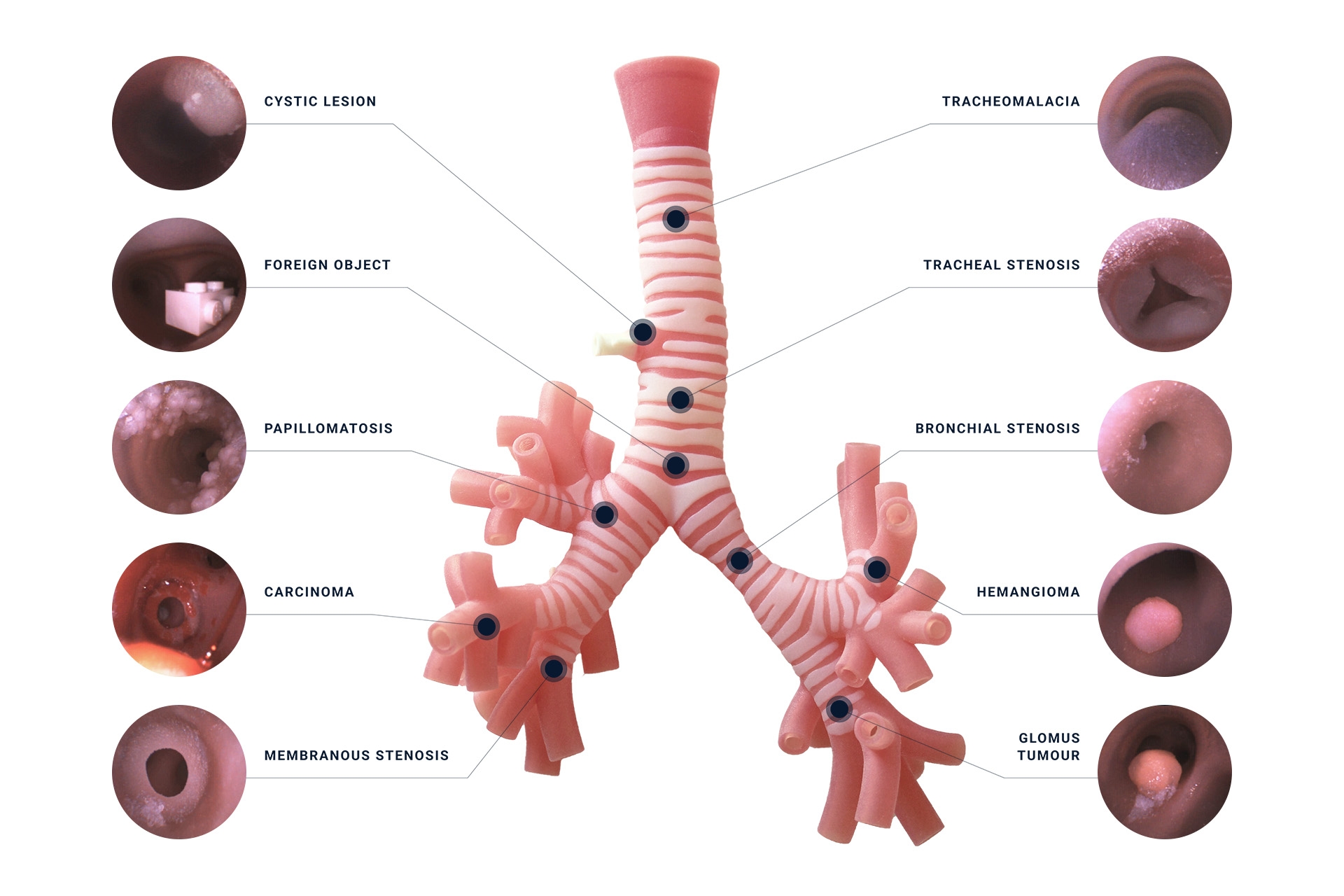 Diagram of dynamic pathology located on inside of simulated trachea.