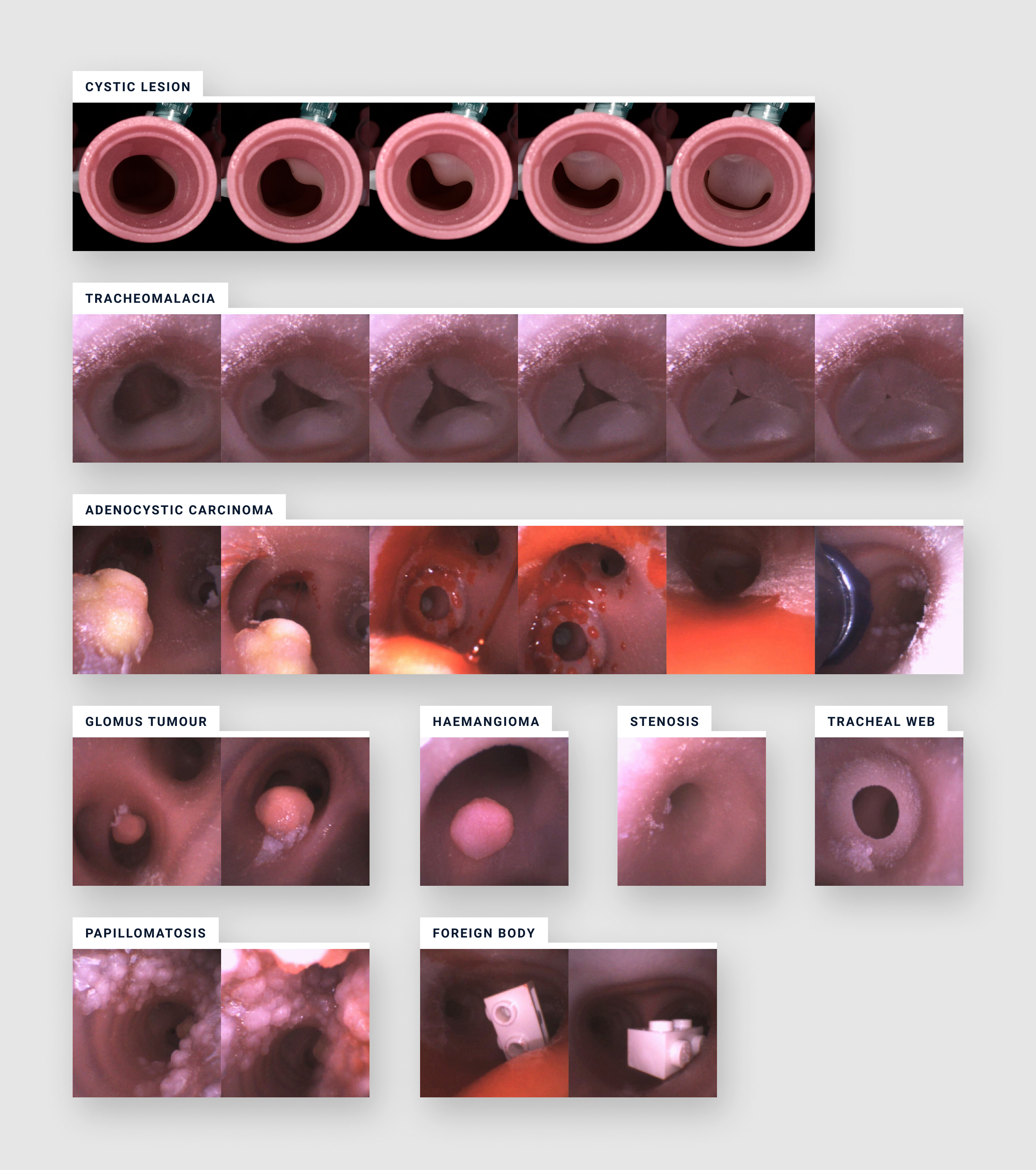 View from bronchoscope exploring inside of trachea model while simulating patient pathology and bodily fluids.